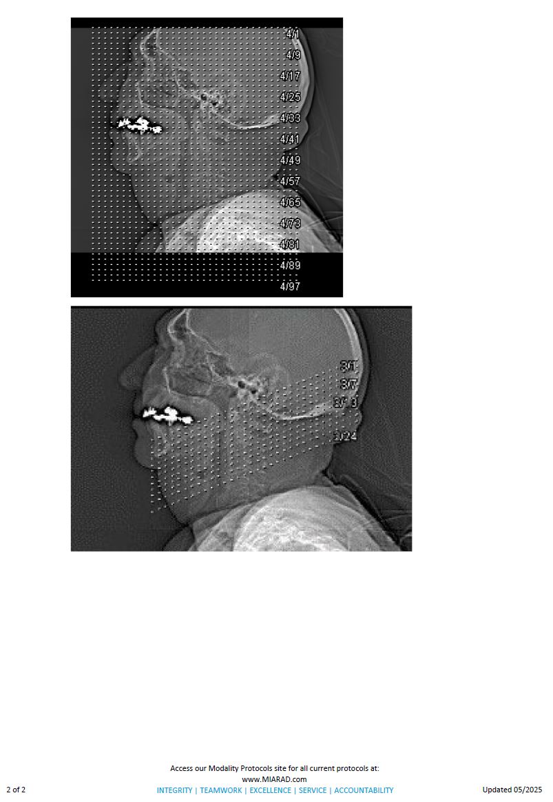 CT Soft Tissue Neck WIthout Contrast 05-2025.1